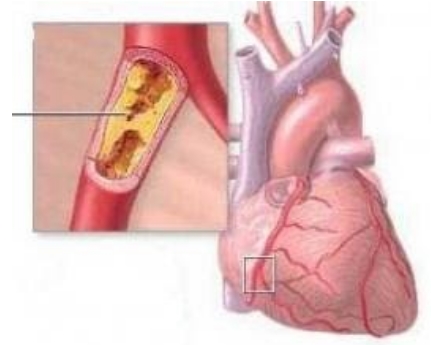 Υπερτασική καρδιοπάθεια